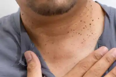 Verrugas en el cuello: causas, tratamientos y cuándo consultar a un dermatólogo