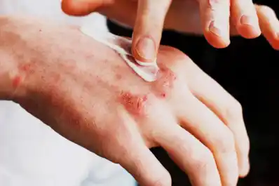 Dermatitis atópica: el peso de las demoras