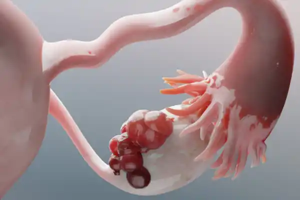 Este tipo de cáncer afecta a mujeres altas y se manifiesta con dolor abdominal