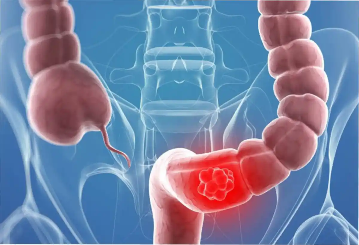 El cáncer de colon puede prevenirse con un medicamento de uso diario, según un estudio.