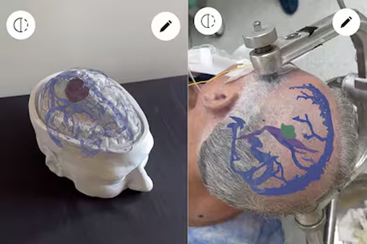 APP PARA CAMBIAR LA NEUROCIRUGÍA. Desde el ITBA desarrollaron un sistema con IA y realidad aumentada que permite operar con precisión a menor costo. / NAVIA