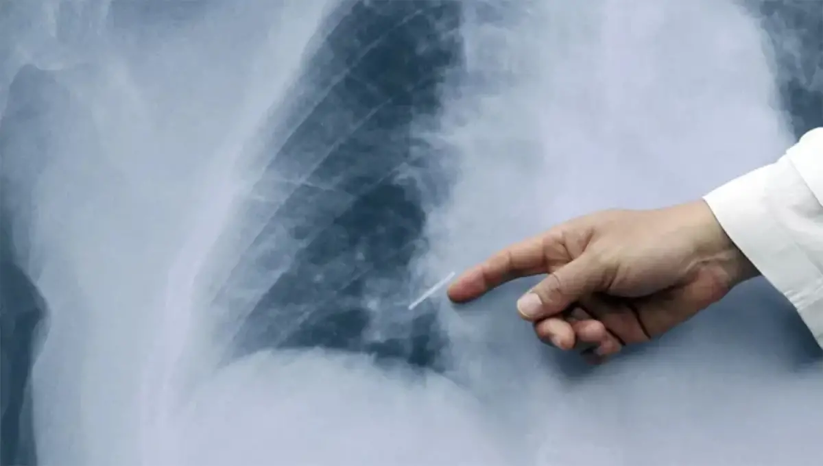 Día Mundial de la Neumonía: es la quinta causa de muerte a nivel mundial