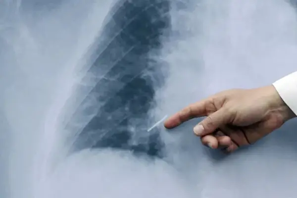 Día Mundial de la Neumonía: es la quinta causa de muerte a nivel mundial