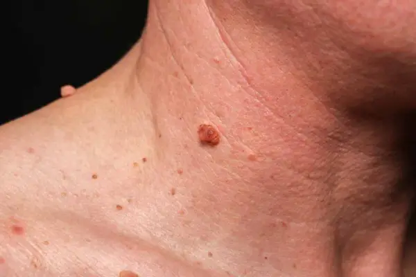 Verrugas en el cuello: qué las causa y cuáles son los tratamientos más efectivos