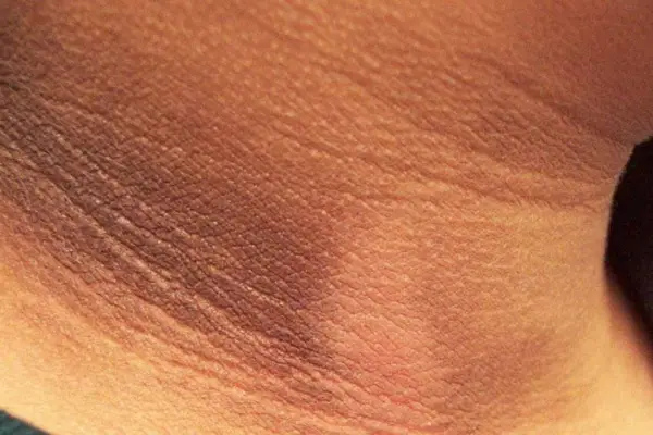 Verrugas y manchas oscuras en el cuello: la señal que podría anticipar una grave enfermedad