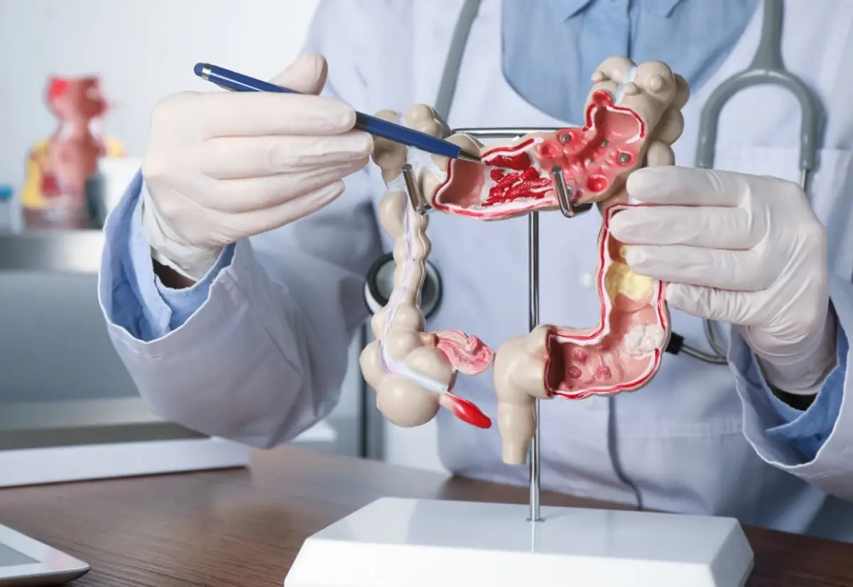 El cáncer colorrectal es uno de los de principal incidencia en Argentina.