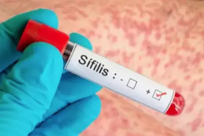 Alerta por contagios de sífilis: cuáles son las provincias argentinas con más casos registrados