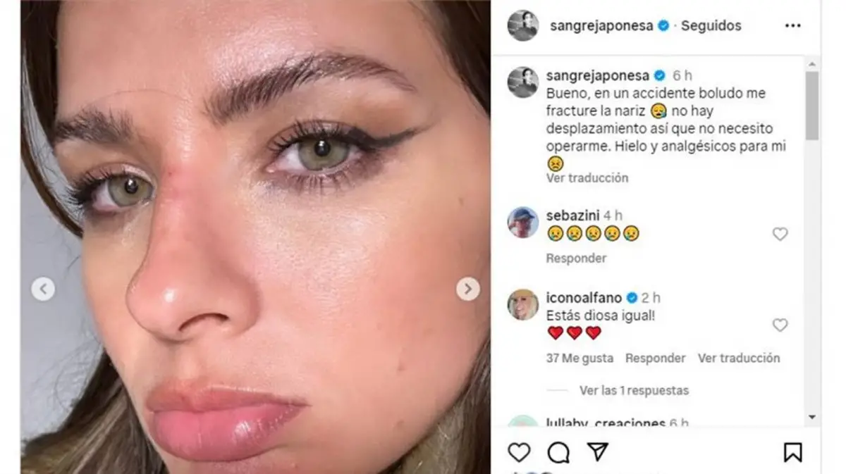 La China Suárez se quebró la nariz en pleno rodaje: ¿cómo quedó tras el golpe?