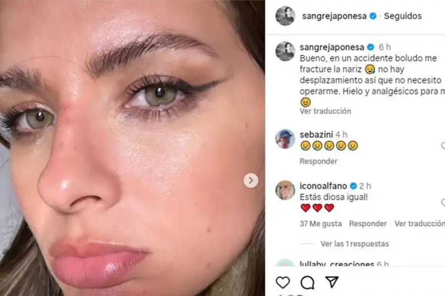 La China Suárez se quebró la nariz en pleno rodaje: ¿cómo quedó tras el golpe?