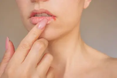 Cómo se contagia el herpes y cuáles son los riesgos de esta infección de transmisión sexual