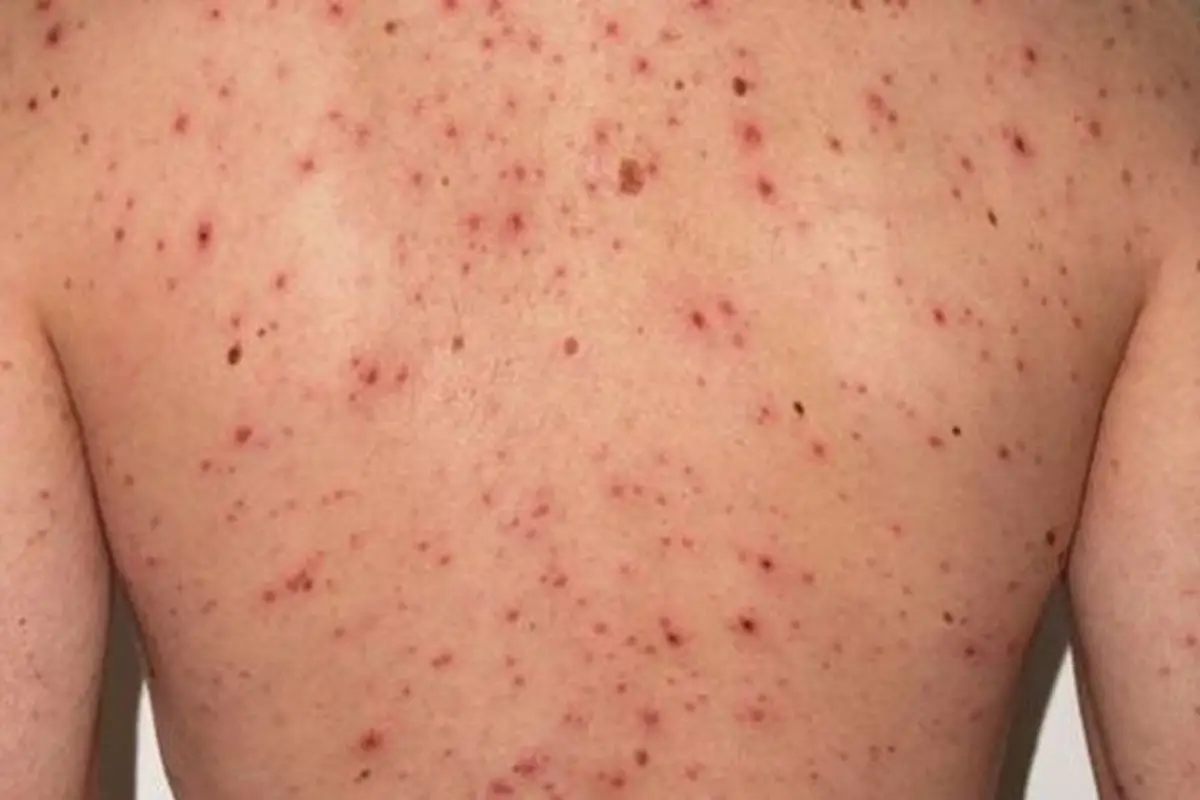 La familia que cruzó el país con sarampión tuvo cerca de 100 contactos estrechos: investigan nuevos casos