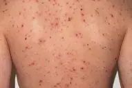 La familia que cruzó el país con sarampión tuvo cerca de 100 contactos estrechos: investigan nuevos casos