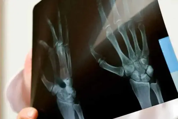 El primer síntoma de cáncer de huesos que una joven detectó a tiempo y le salvó la vida