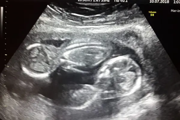 Nacieron trigemelas en Chubut: cuáles son las características de un embarazo múltiple