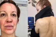 Miriam Lanzoni y su duro relato: la enfermedad que la obligó a dormir envuelta en papel film