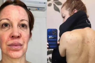 Miriam Lanzoni y su duro relato: la enfermedad que la obligó a dormir envuelta en papel film