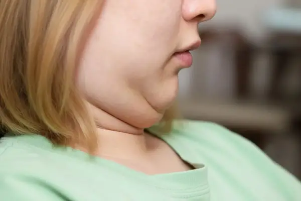 Seis ejercicios sencillos para reducir la papada y mejorar la armonía facial