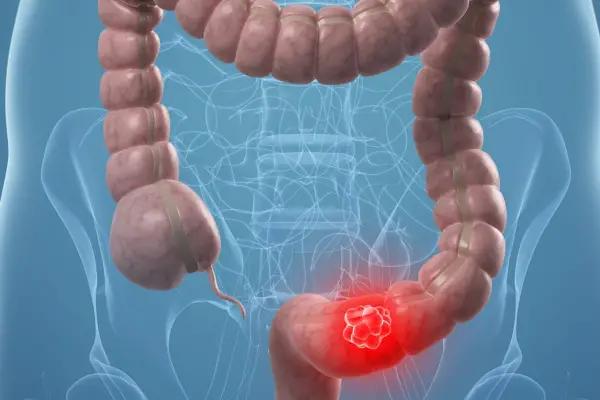 El cáncer de colon se convirtió en la principal causa de muertes oncológicas entre los jóvenes