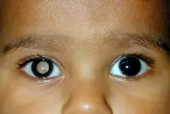 Cuál es el cáncer ocular infantil que puede detectarse de forma temprana