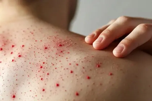 Mundial 2026: el Ministerio de Salud de Tucumán alertó por riesgo de sarampión en países sede