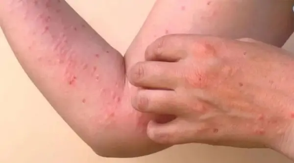 Chikungunya en Tucumán: así es la infección que dobla el cuerpo de dolor