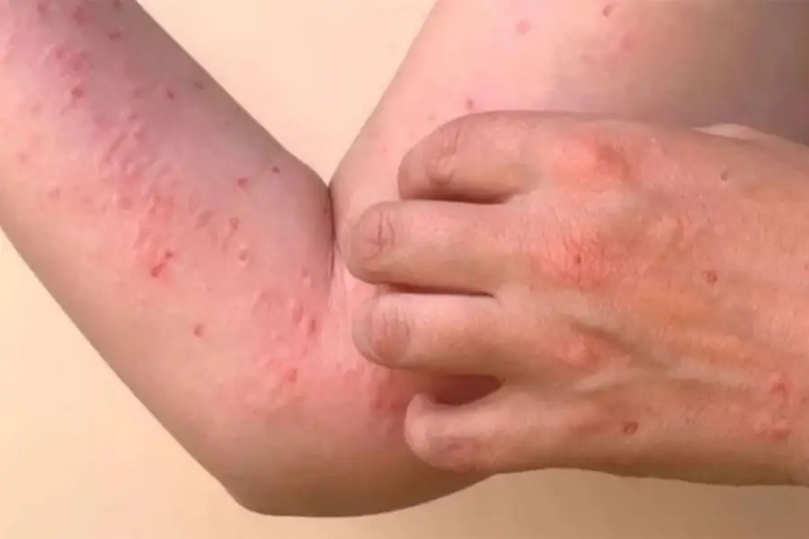 UNO DE LOS SÍNTOMAS. Además del dolor articular intenso, la chikungunya puede provocar erupciones en tronco y extremidades.