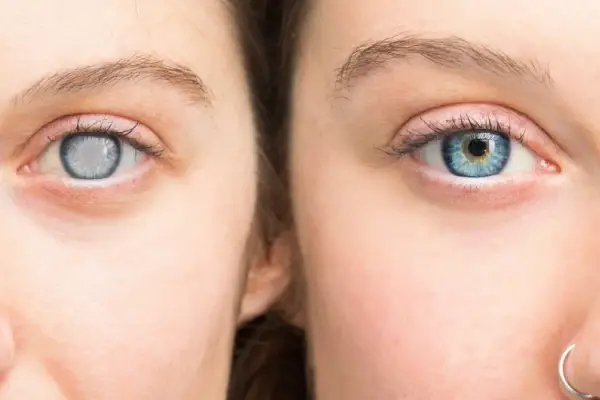 Para un mundo libre de glaucoma es necesaria la detección temprana