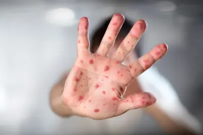 Detectaron el primer caso de viruela del mono sin antecedente de viaje en Argentina