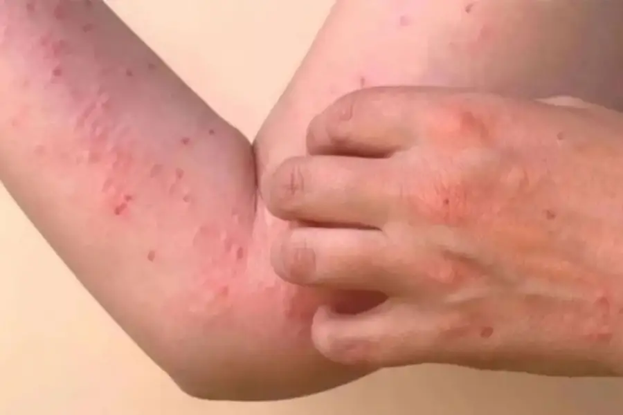 SÍNTOMAS. El sarpullido puede aparecer días después de la fiebre alta.