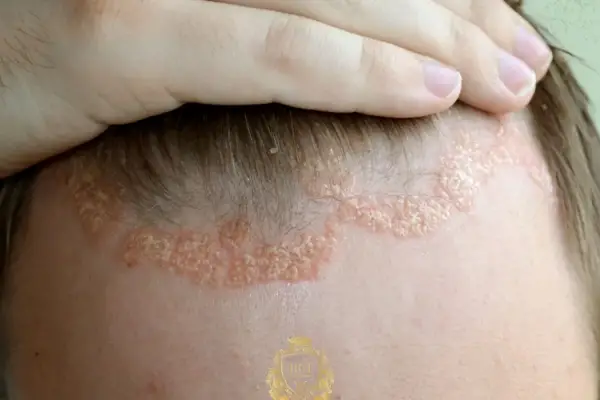 Estados Unidos aprobó una pastilla para la psoriasis que promete eliminar lesiones cutáneas