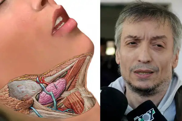 Qué es el cistoadenoma parotídeo bilateral, el tumor por el que operaron a Máximo Kirchner