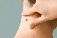 Alarma por el aumento de casos de melanoma en la generación z