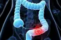 Los vegetales que pueden reducir hasta en un 20% el riesgo de cáncer de colon, según un estudio