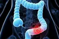 Los vegetales que pueden reducir hasta en un 20% el riesgo de cáncer de colon, según un estudio