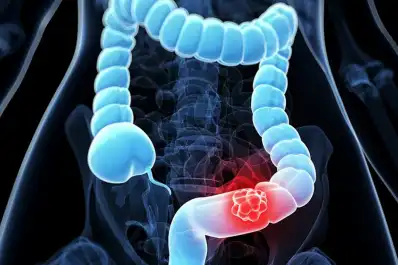 Los vegetales que pueden reducir hasta en un 20% el riesgo de cáncer de colon, según un estudio