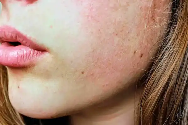 Piel seca en invierno: las causas y los trucos para mantenerla hidratada