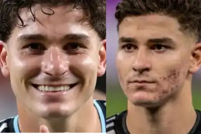 Julián Álvarez mostró la transformación de su piel tras cuatro años: el tratamiento que cambió su rostro