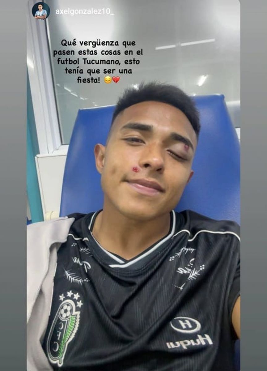 Un delantero de Concepción FC mostró cómo quedó tras recibir un balazo de goma en la final de la Liga Tucumana