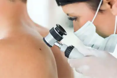 Yerba Buena: realizarán controles gratuitos de lunares para prevenir el cáncer de piel