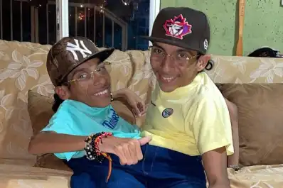 Nacimos juntos, morimos juntos: la historia de los siameses ecuatorianos que fallecieron a los 27 años
